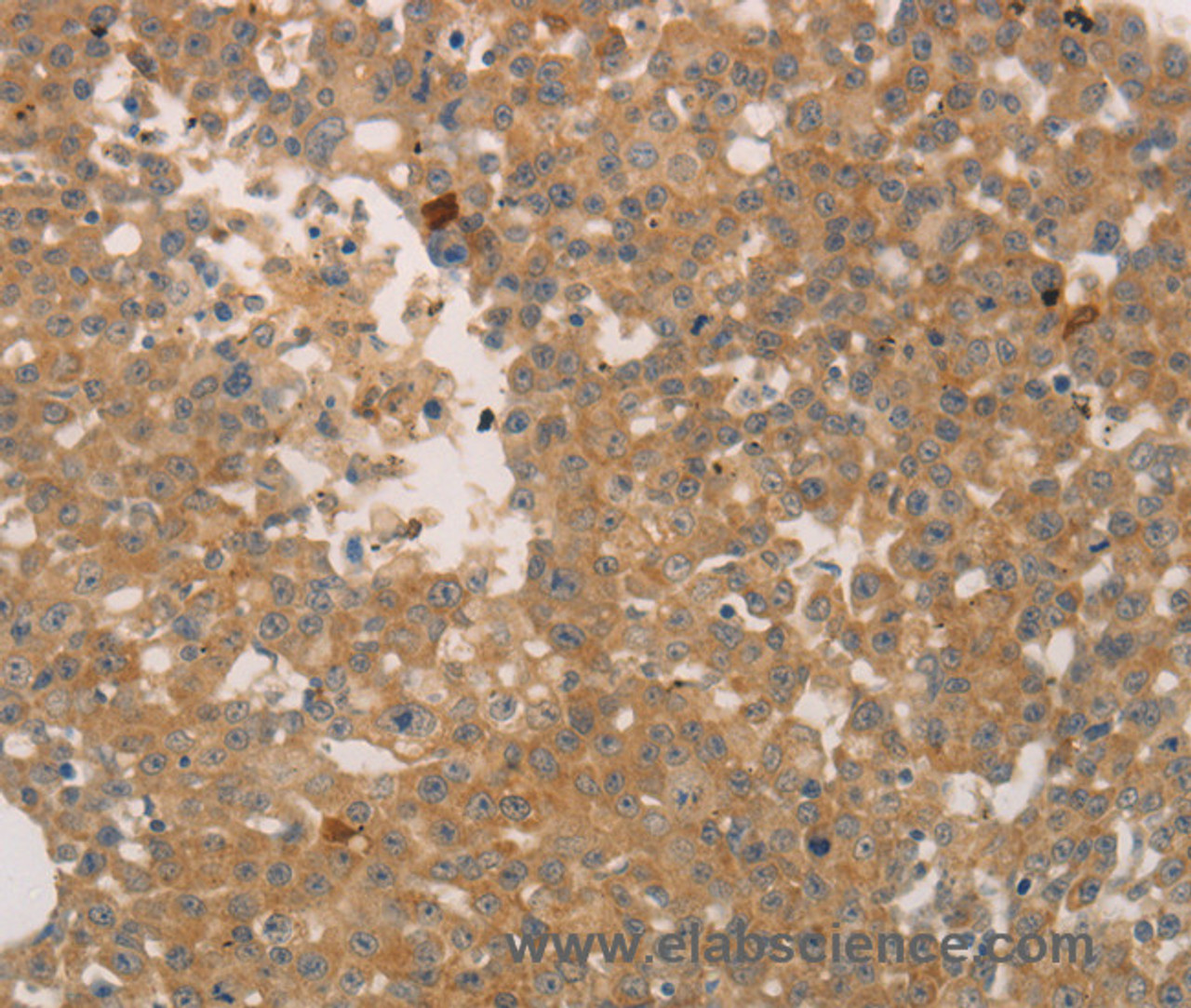 Immunohistochemistry of paraffin-embedded Human breast cancer using ADCYAP1R1 Polyclonal Antibody at dilution of 1:70
