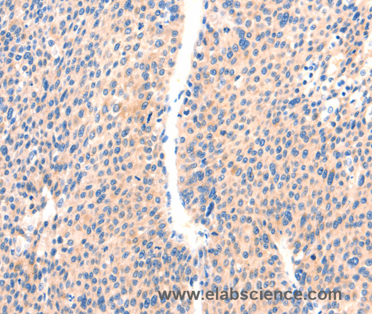 Immunohistochemistry of paraffin-embedded Human liver cancer using PAFAH2 Polyclonal Antibody at dilution of 1:80