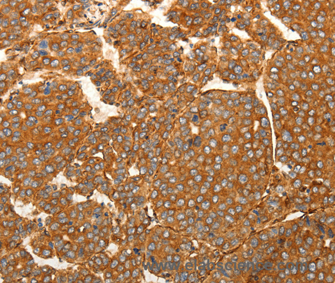 Immunohistochemistry of paraffin-embedded Human liver cancer tissue using SFRP1 Polyclonal Antibody at dilution 1:80
