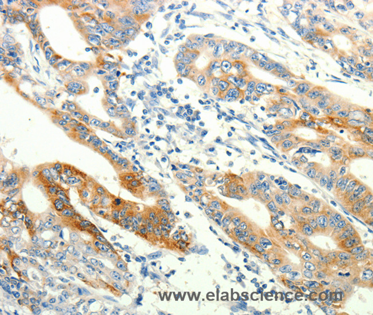 Immunohistochemistry of paraffin-embedded Human gasrtic cancer tissue using TRPA1 Polyclonal Antibody at dilution 1:60