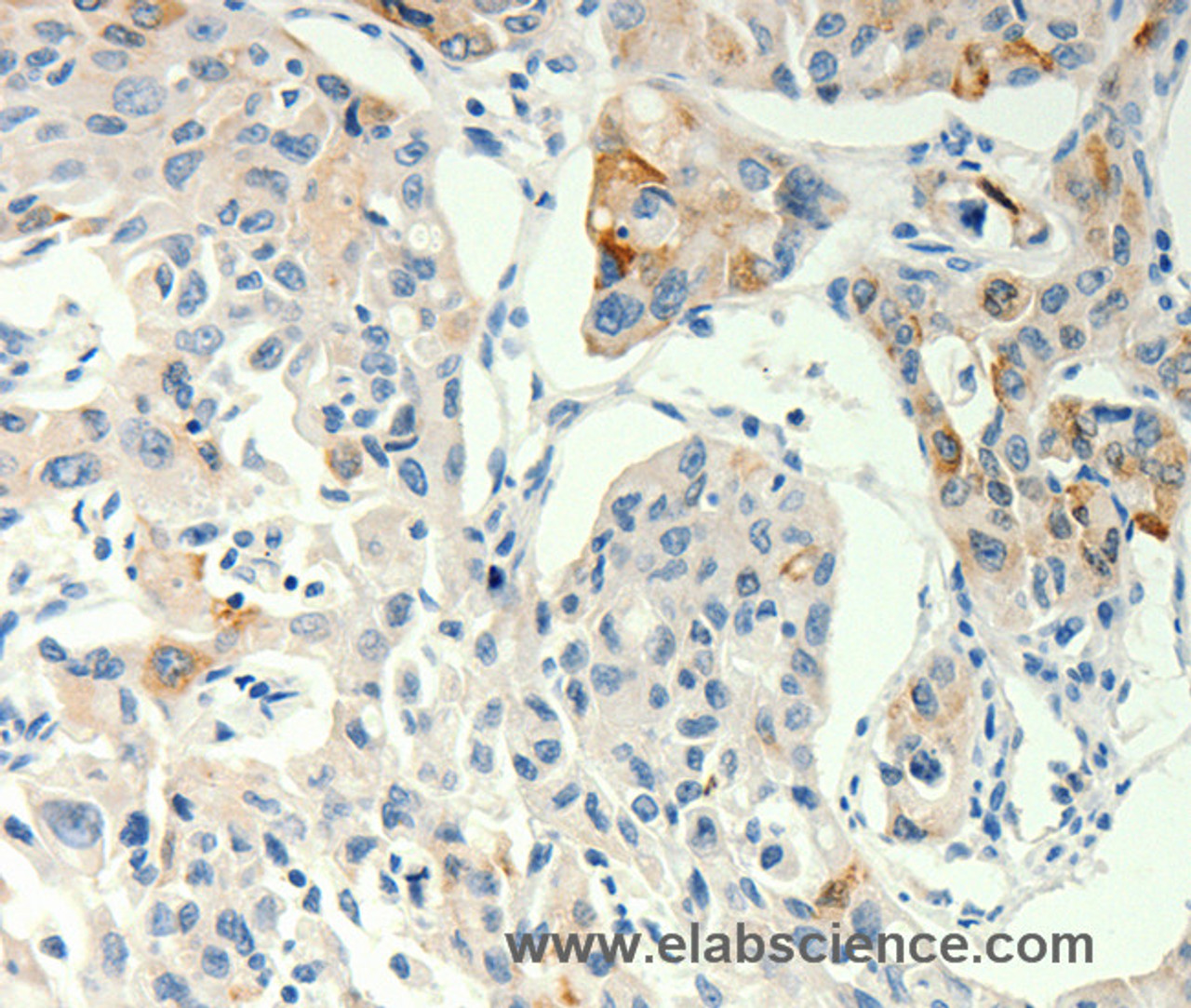 Immunohistochemistry of paraffin-embedded Human lung cancer tissue using TRPA1 Polyclonal Antibody at dilution 1:60