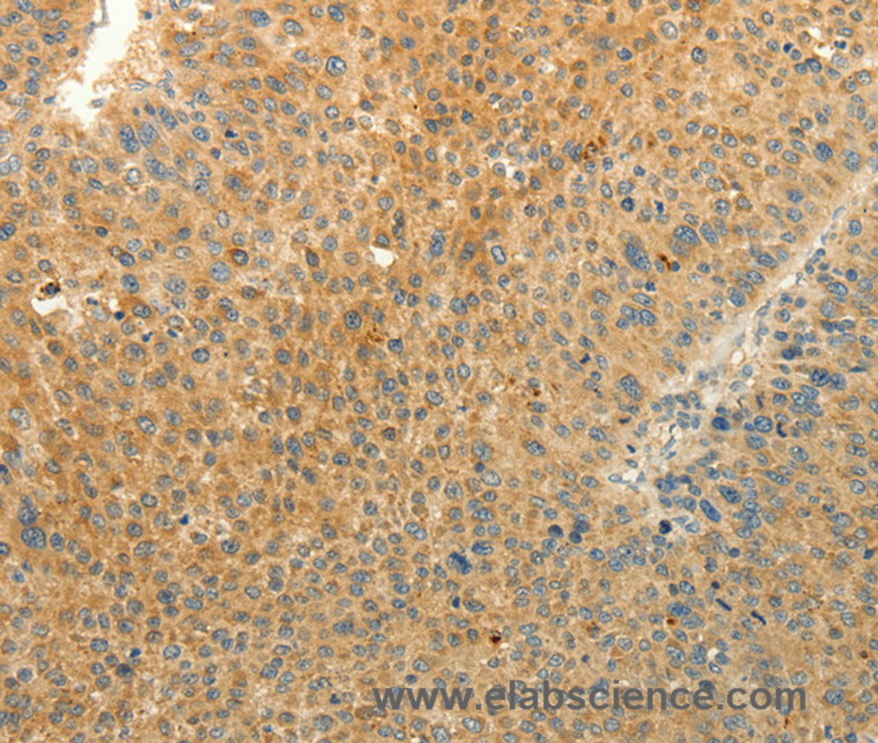 Immunohistochemistry of paraffin-embedded Human liver cancer tissue using EDG7 Polyclonal Antibody at dilution 1:40