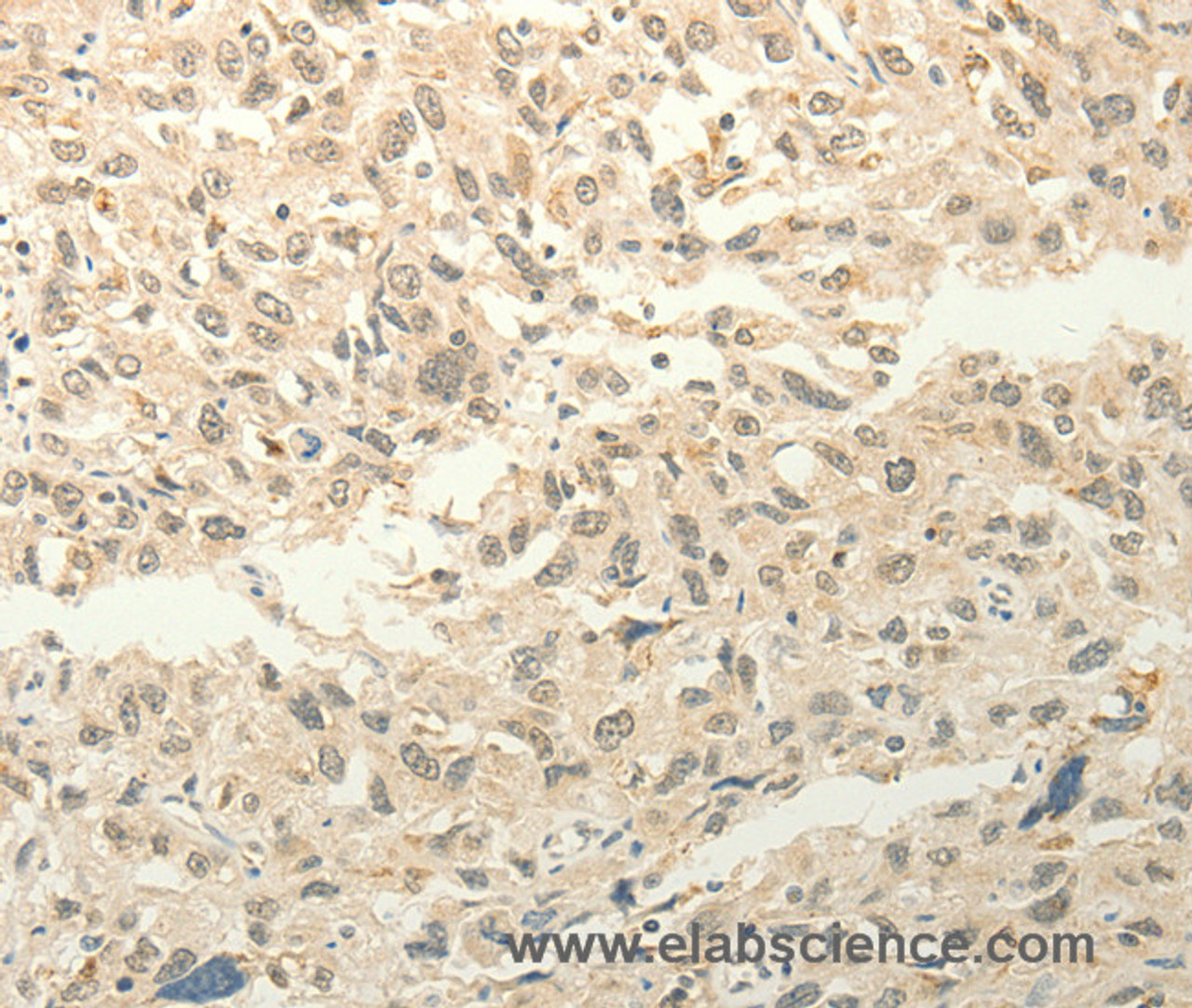 Immunohistochemistry of paraffin-embedded Human esophagus cancer tissue using FZD8 Polyclonal Antibody at dilution 1:50
