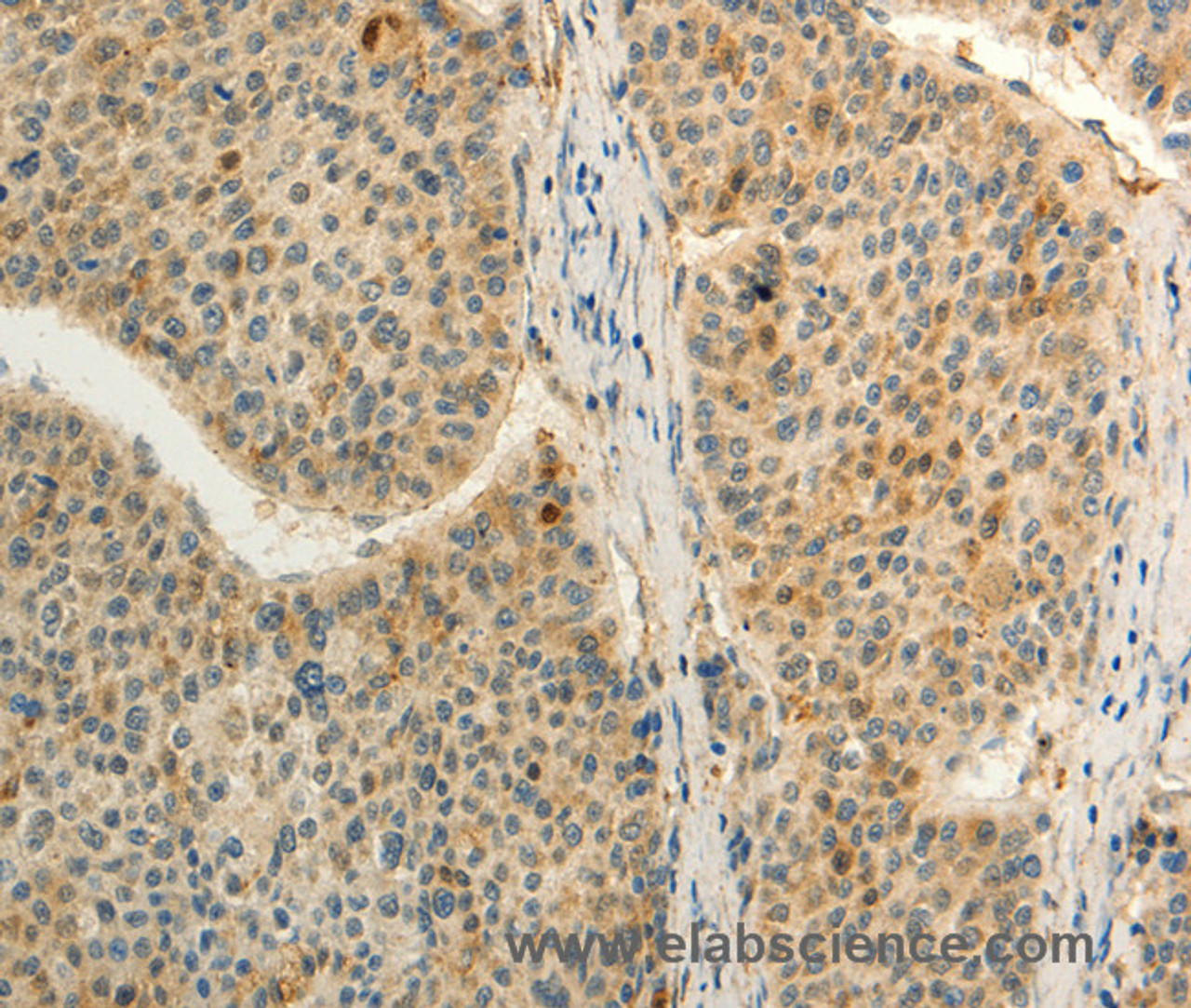 Immunohistochemistry of paraffin-embedded Human liver cancer tissue using FZD8 Polyclonal Antibody at dilution 1:50