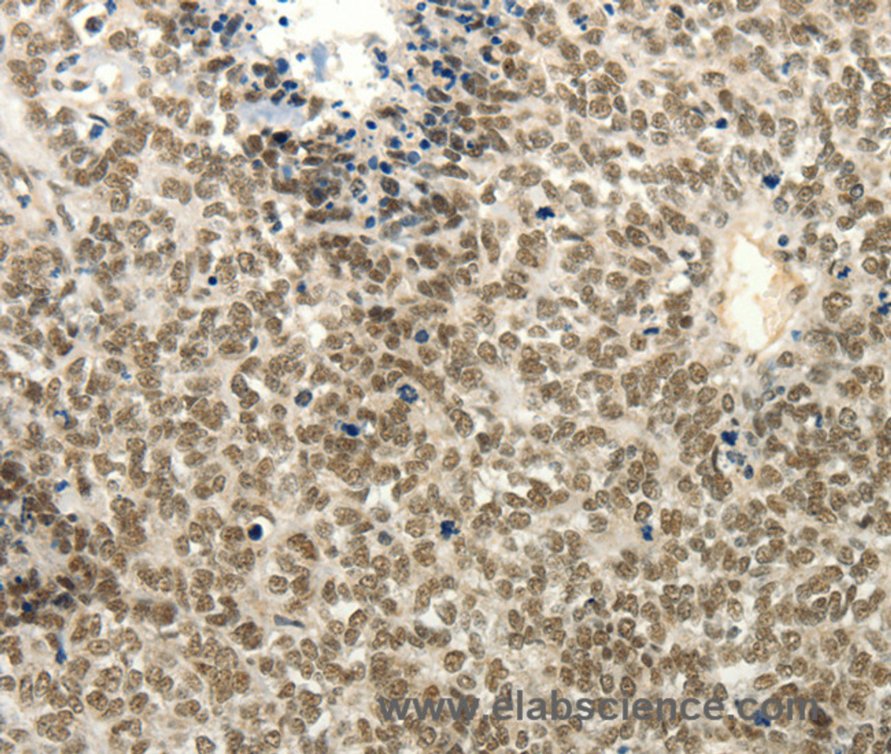 Immunohistochemistry of paraffin-embedded Human ovarian cancer tissue using Frizzled 10 Polyclonal Antibody at dilution 1:50