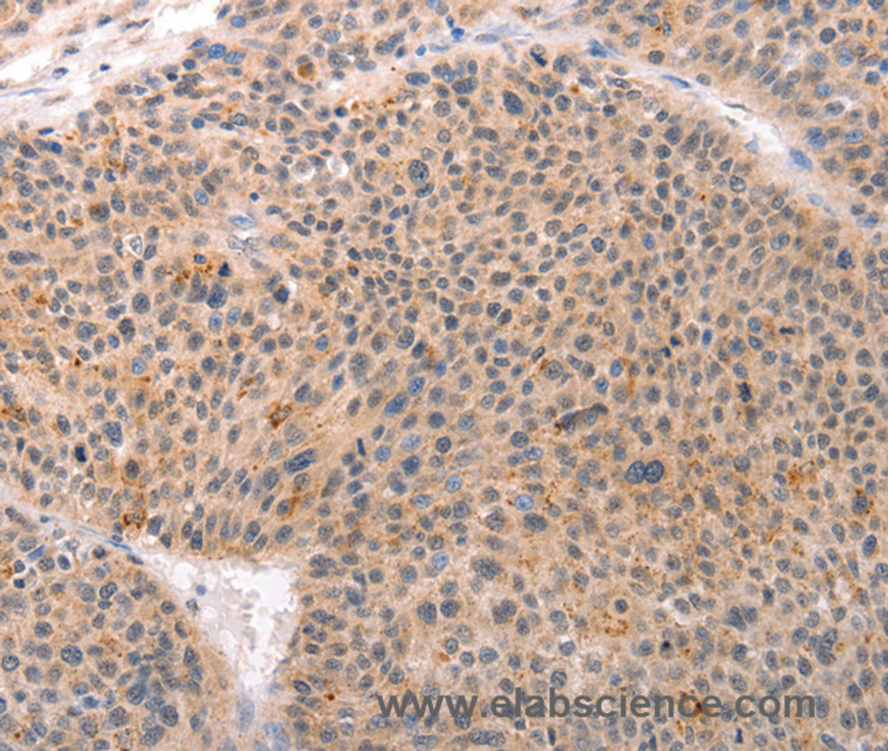Immunohistochemistry of paraffin-embedded Human esophagus cancer tissue using ACIN1 Polyclonal Antibody at dilution 1:80