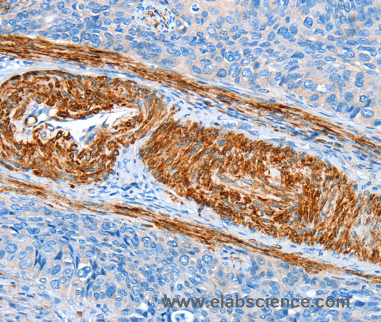 Immunohistochemistry of paraffin-embedded Human cervical cancer tissue using AARS Polyclonal Antibody at dilution 1:60