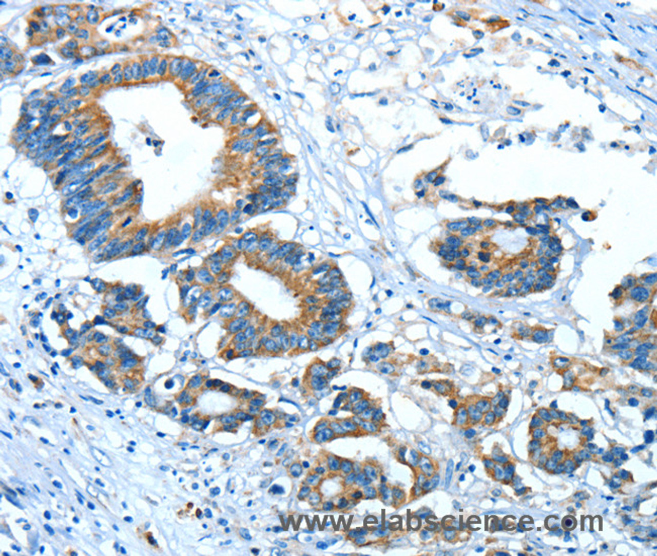 Immunohistochemistry of paraffin-embedded Human colon cancer using GLRA1 Polyclonal Antibody at dilution of 1:30