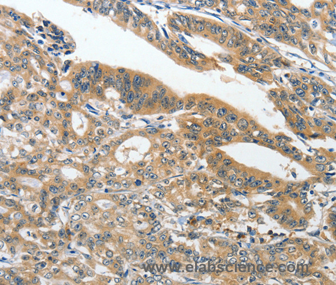 Immunohistochemistry of paraffin-embedded Human gasrtic cancer tissue using ANKZF1 Polyclonal Antibody at dilution 1:40