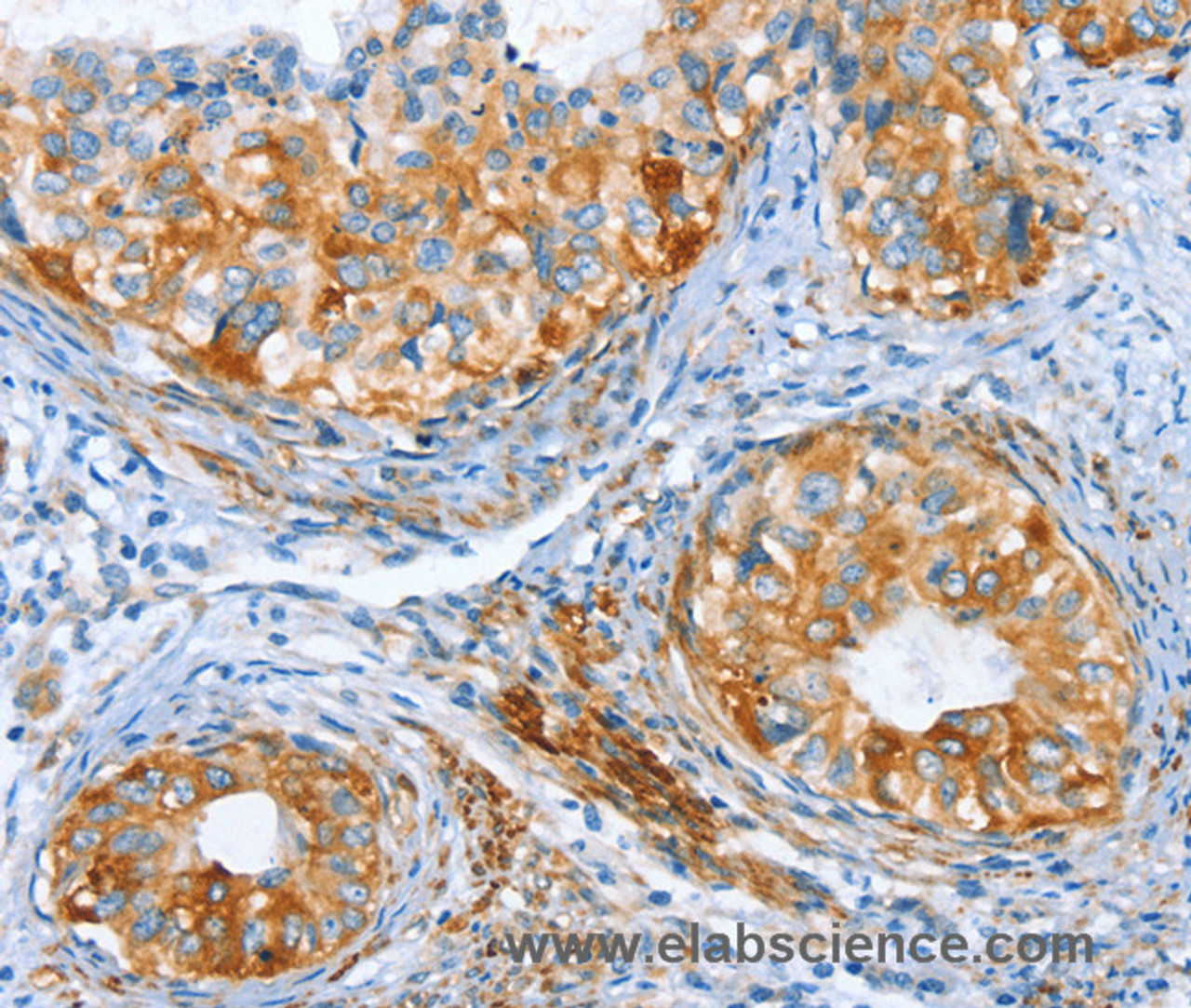Immunohistochemistry of paraffin-embedded Human cervical cancer tissue using AIP Polyclonal Antibody at dilution 1:80