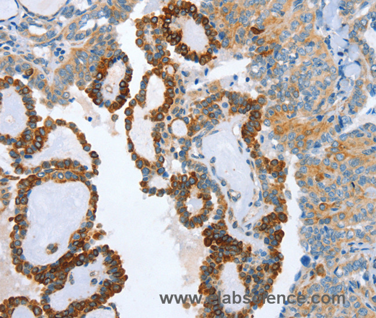 Immunohistochemistry of paraffin-embedded Human thyroid cancer tissue using AIP Polyclonal Antibody at dilution 1:80