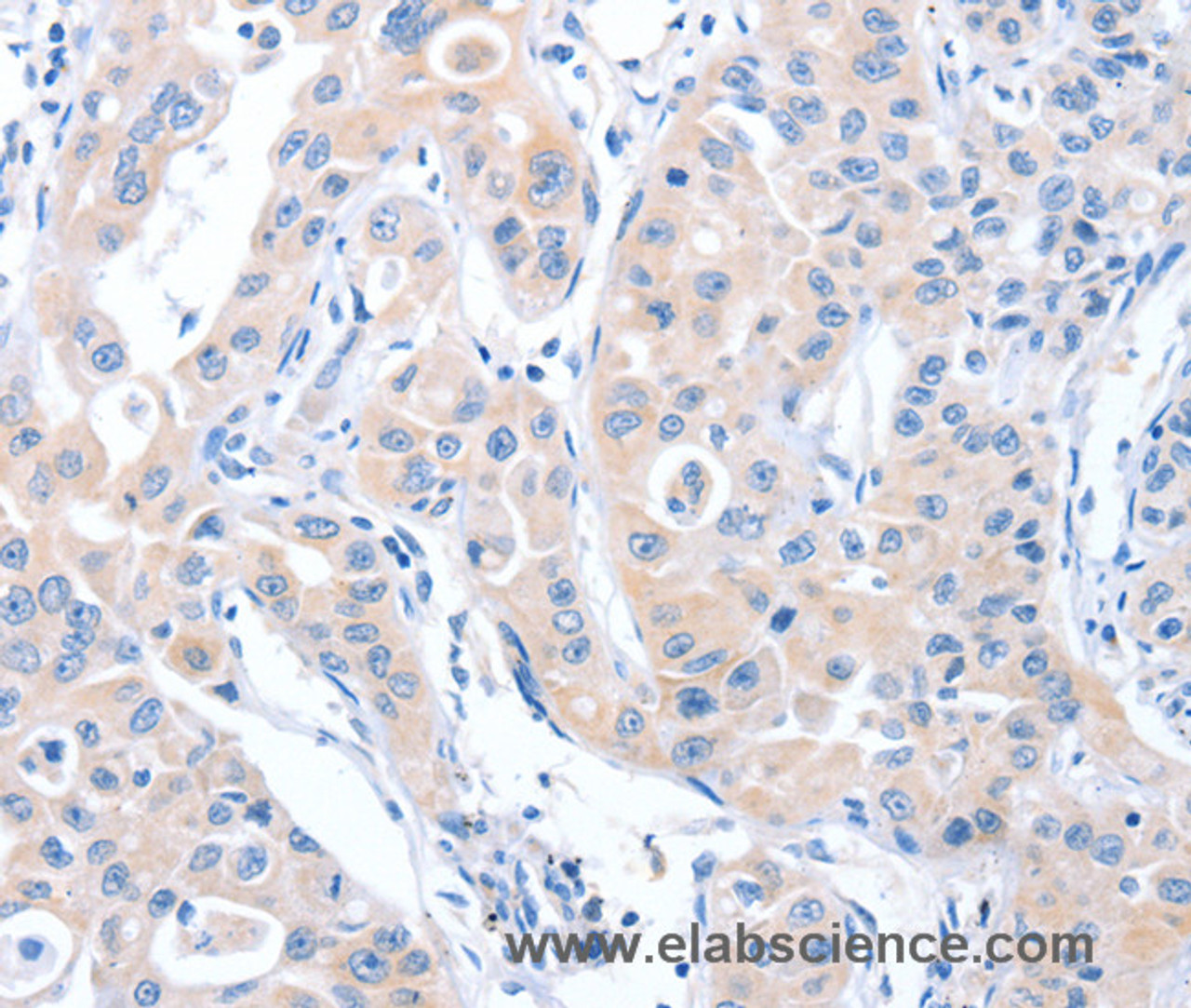 Immunohistochemistry of paraffin-embedded Human lung cancer tissue using ARHGEF6 Polyclonal Antibody at dilution 1:70
