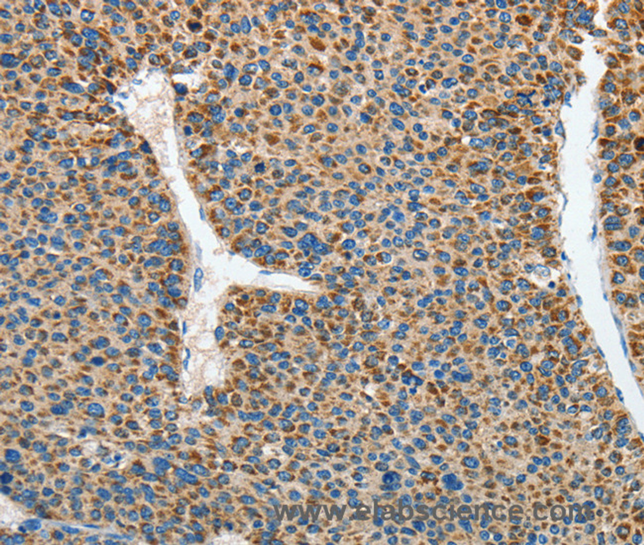 Immunohistochemistry of paraffin-embedded Human liver cancer using DSCR1 Polyclonal Antibody at dilution of 1:45