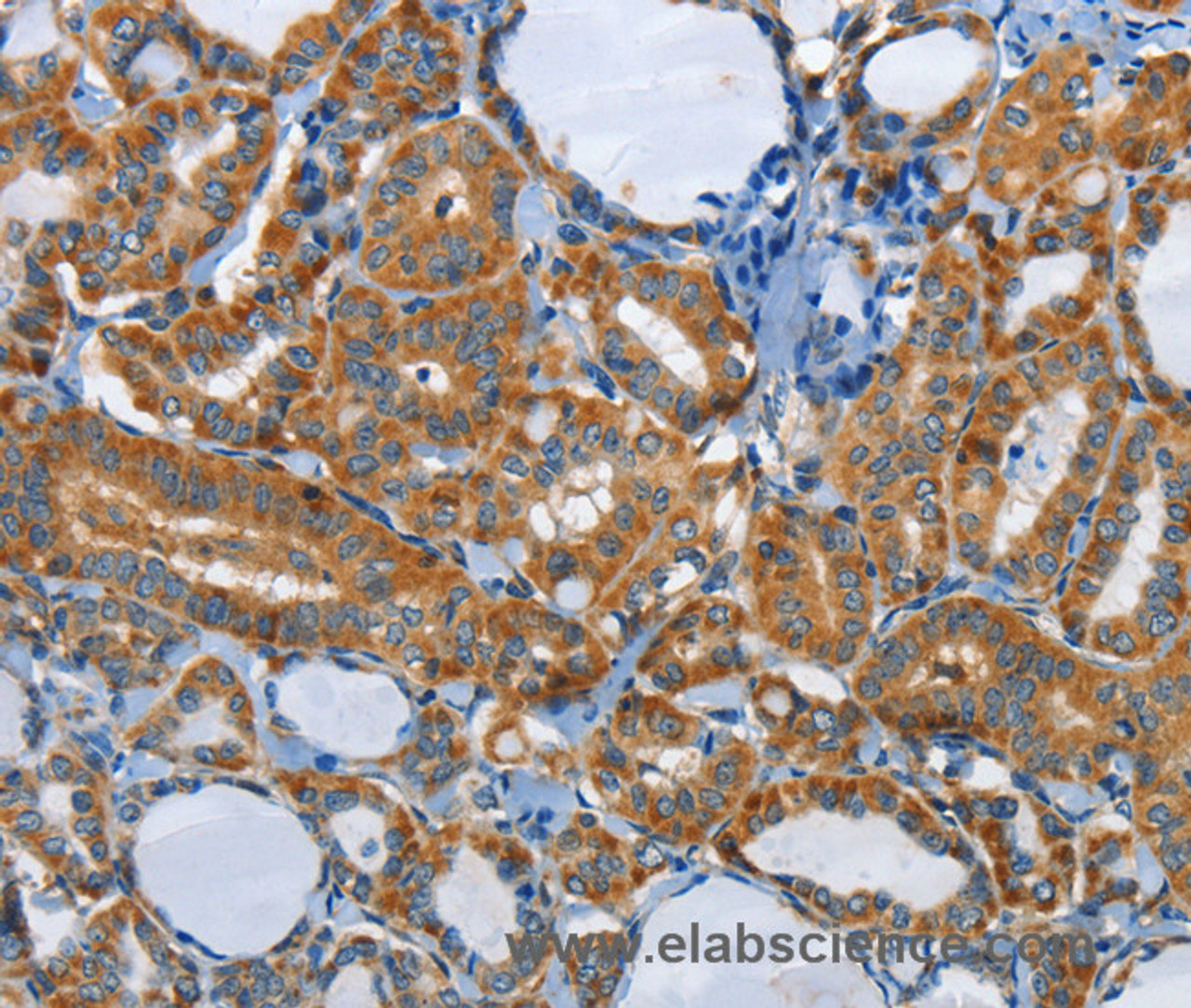 Immunohistochemistry of paraffin-embedded Human thyroid cancer tissue using PIK3R4 Polyclonal Antibody at dilution 1:85