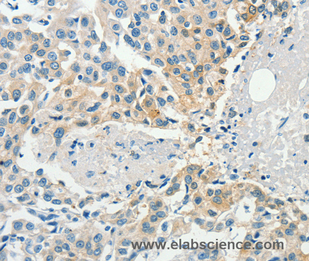 Immunohistochemistry of paraffin-embedded Human breast cancer tissue using DGK beta Polyclonal Antibody at dilution 1:60