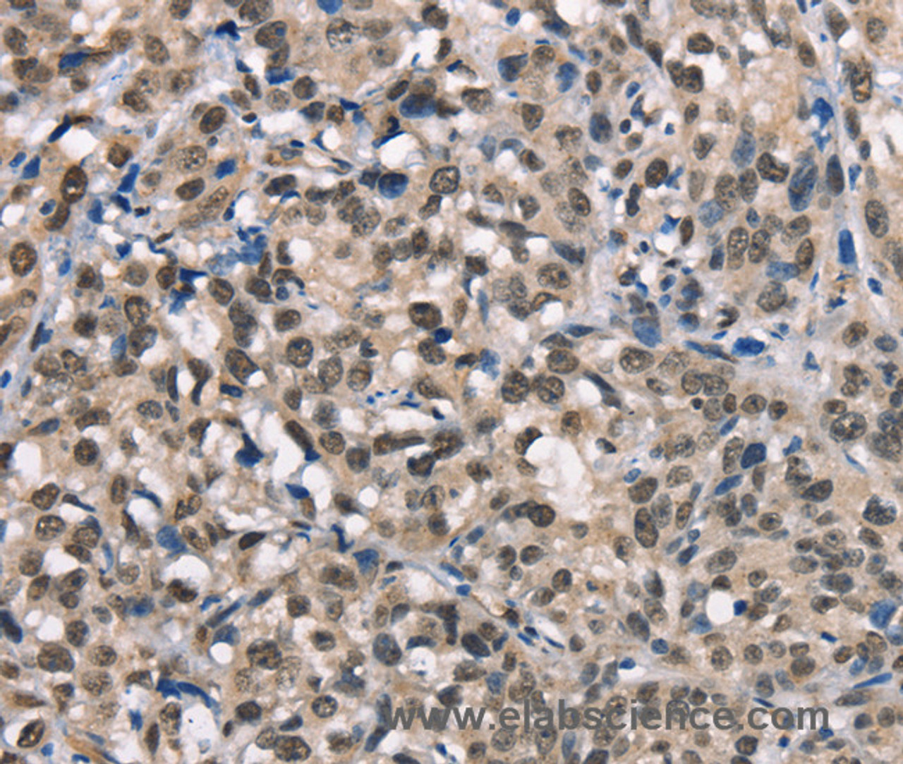 Immunohistochemistry of paraffin-embedded Human esophagus cancer using NSMCE3 Polyclonal Antibody at dilution of 1:40
