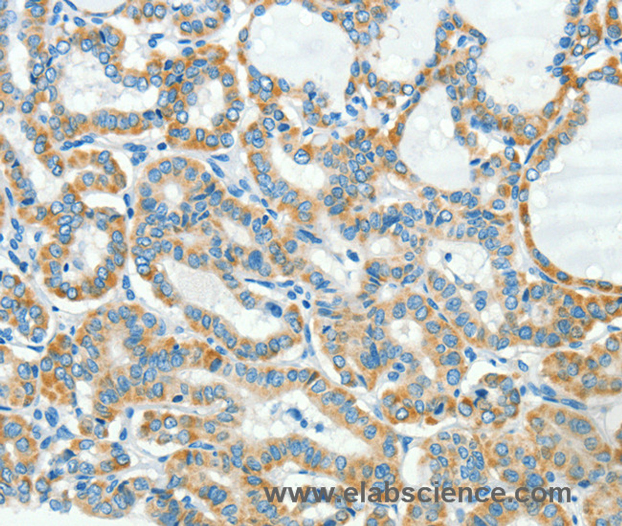 Immunohistochemistry of paraffin-embedded Human thyroid cancer tissue using L1CAM Polyclonal Antibody at dilution 1:40