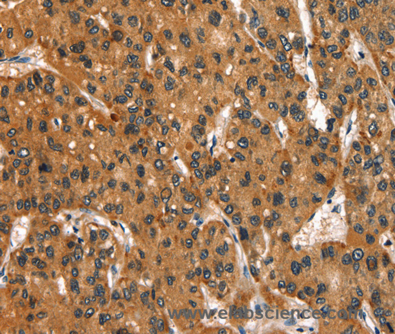 Immunohistochemistry of paraffin-embedded Human liver cancer tissue using SLC6A4 Polyclonal Antibody at dilution of 1:50