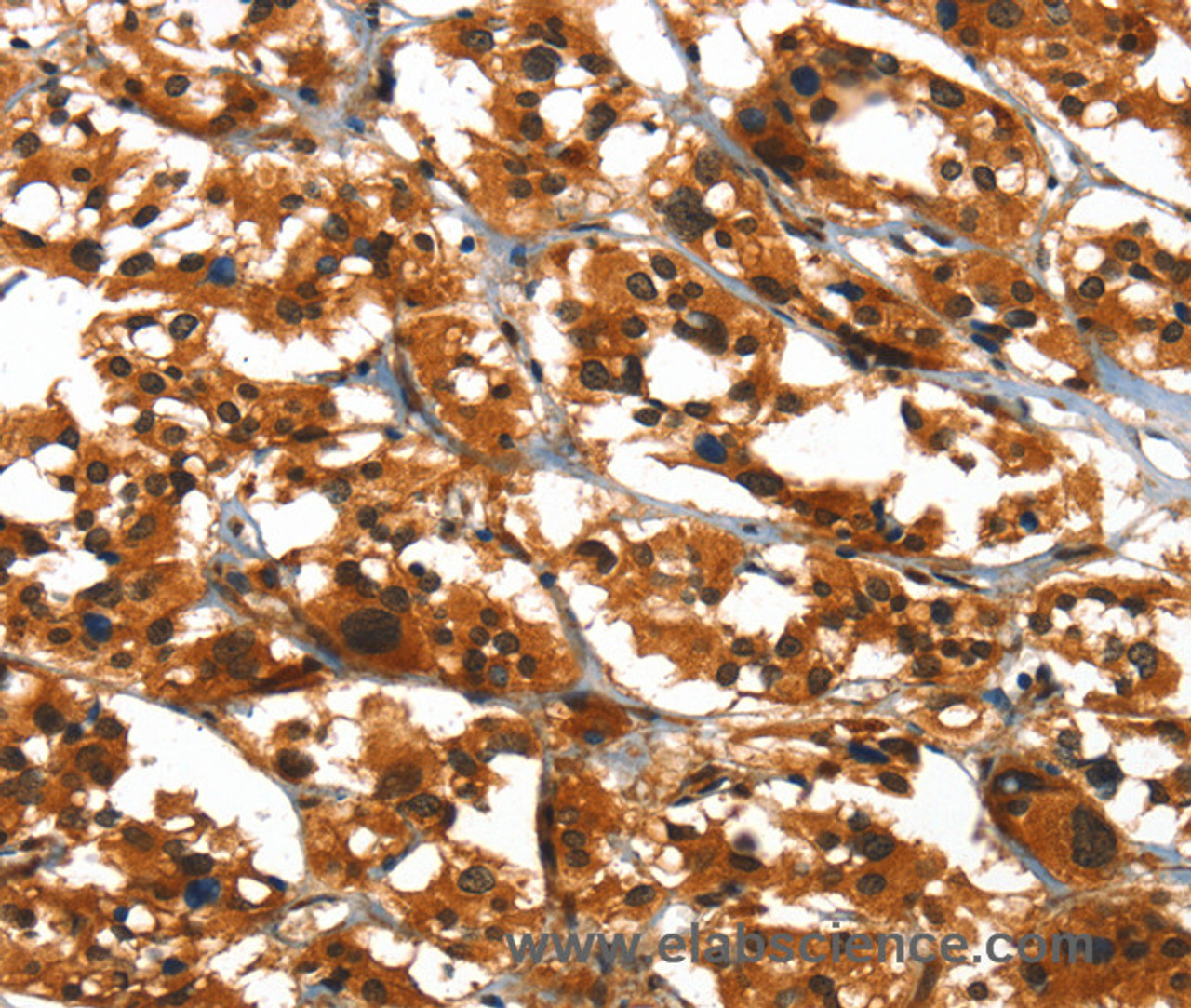 Immunohistochemistry of paraffin-embedded Human thyroid cancer using SLC6A4 Polyclonal Antibody at dilution of 1:50