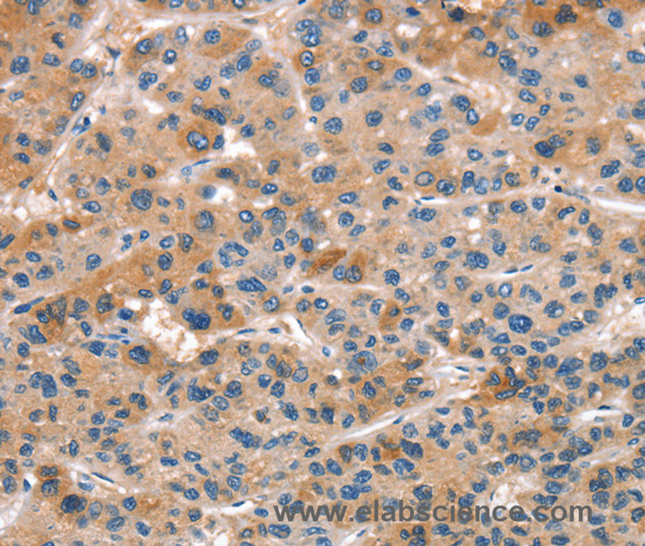 Immunohistochemistry of paraffin-embedded Human liver cancer tissue using ALOX15 Polyclonal Antibody at dilution 1:50
