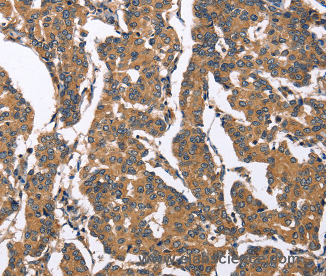 Immunohistochemistry of paraffin-embedded Human breast cancer tissue using BNIP2 Polyclonal Antibody at dilution 1:50