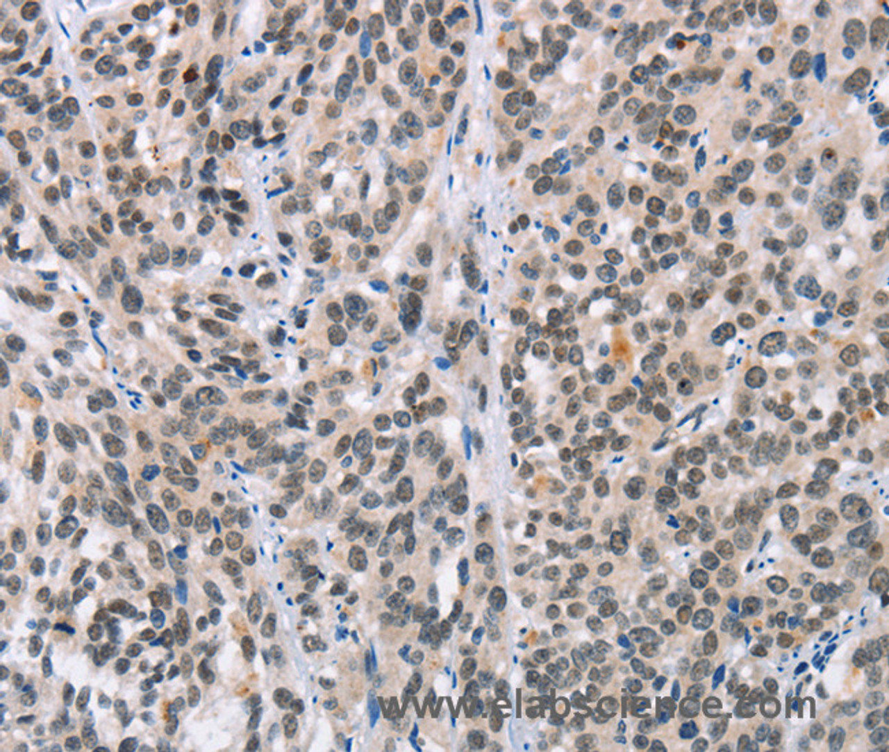 Immunohistochemistry of paraffin-embedded Human esophagus cancer tissue using ADNP Polyclonal Antibody at dilution 1:50