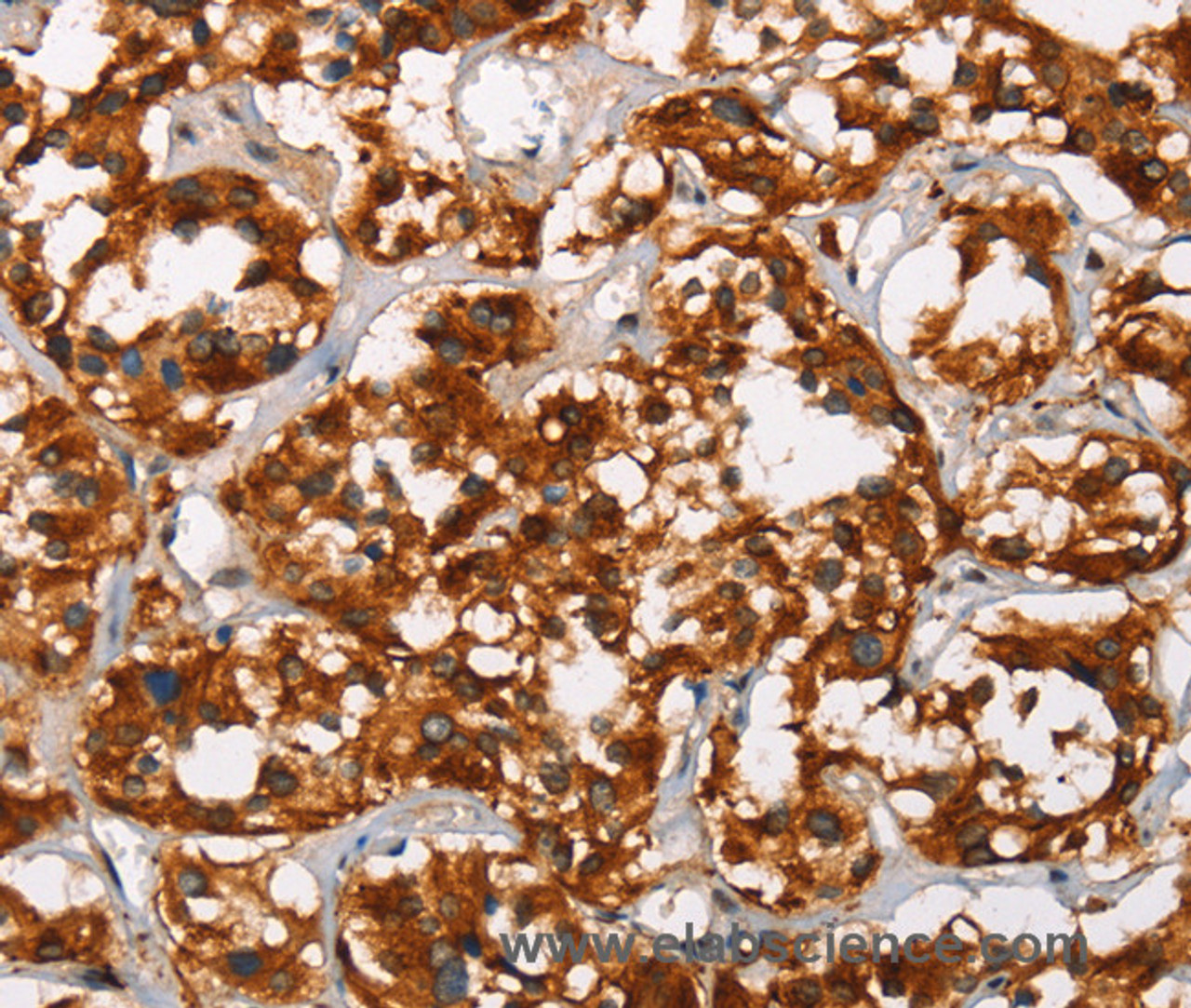Immunohistochemistry of paraffin-embedded Human thyroid cancer tissue using ADNP Polyclonal Antibody at dilution 1:50