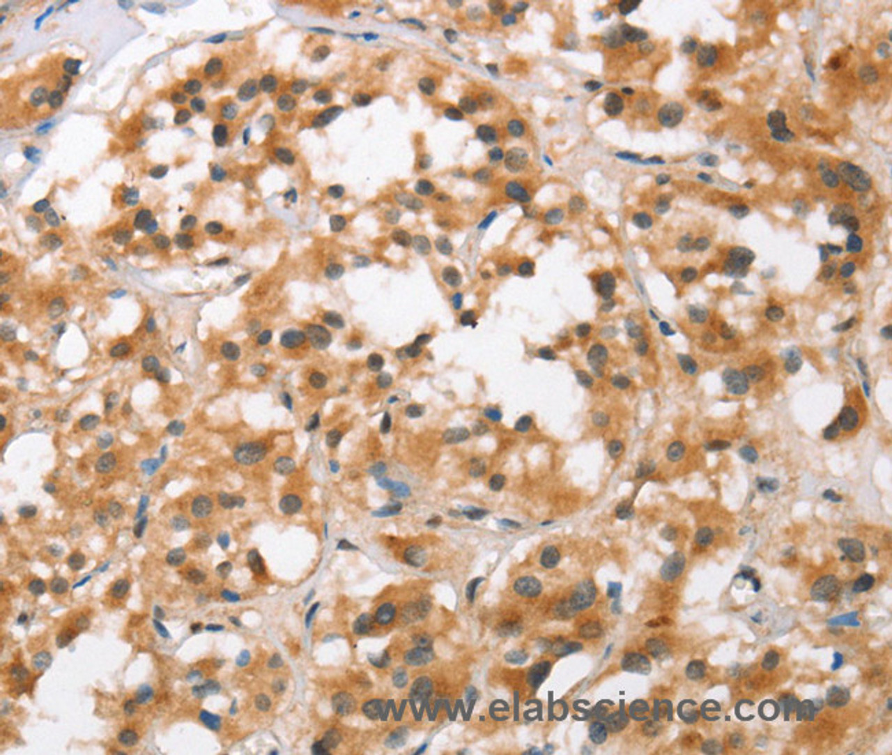 Immunohistochemistry of paraffin-embedded Human thyroid cancer using BCAS4 Polyclonal Antibody at dilution of 1:50