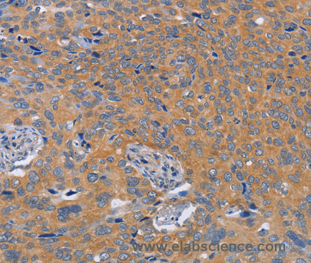 Immunohistochemistry of paraffin-embedded Human cervical cancer tissue using BOD1 Polyclonal Antibody at dilution 1:60