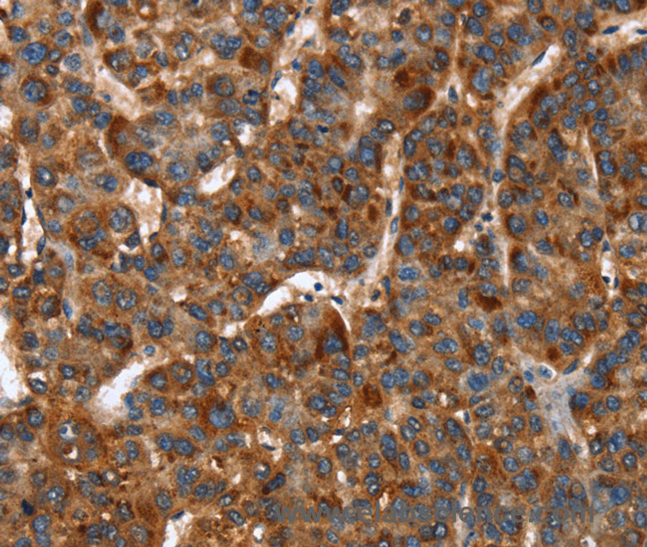 Immunohistochemistry of paraffin-embedded Human liver cancer tissue using CACNB2 Polyclonal Antibody at dilution 1:30