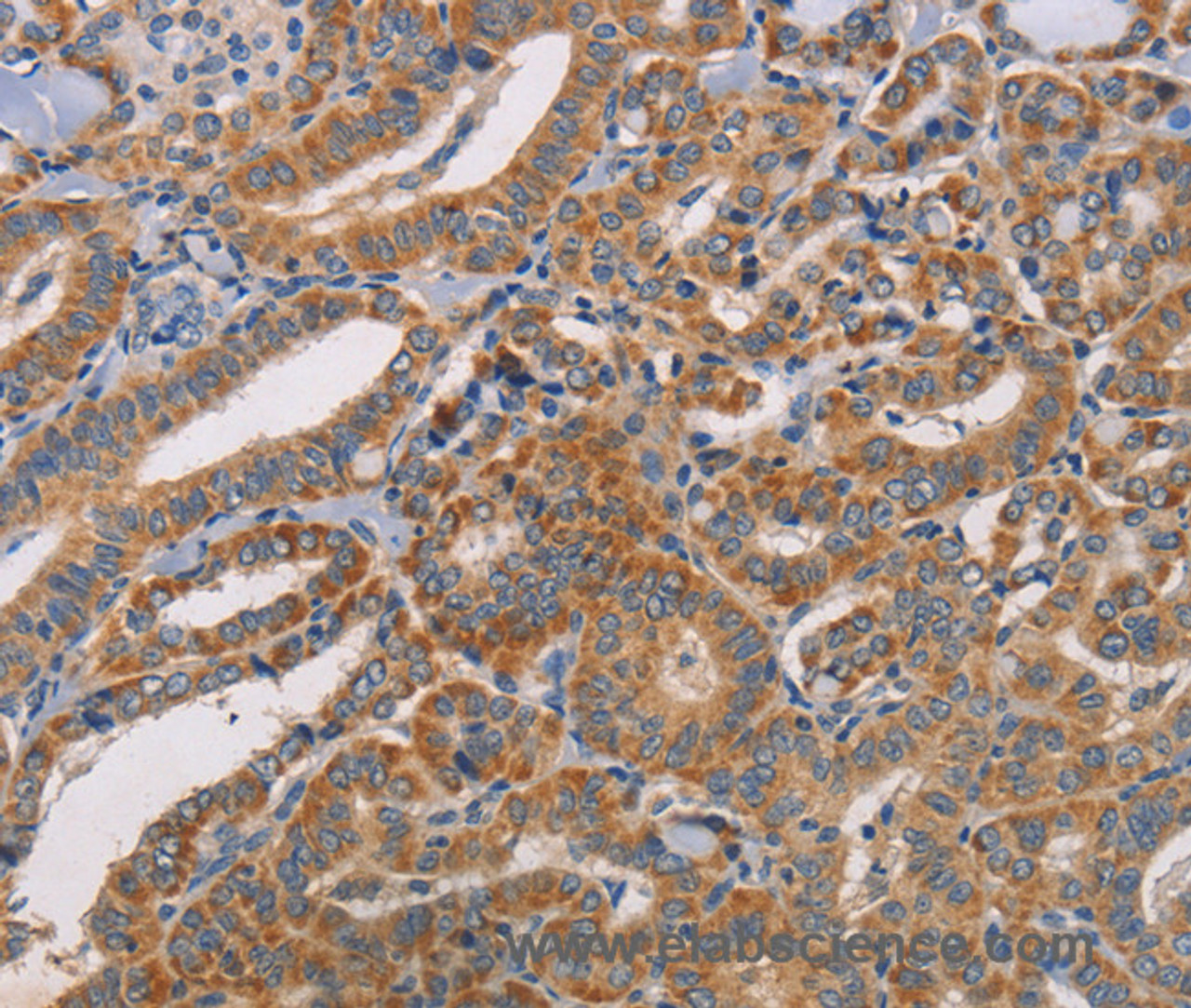 Immunohistochemistry of paraffin-embedded Human thyroid cancer tissue using CDK11A/B Polyclonal Antibody at dilution 1:50