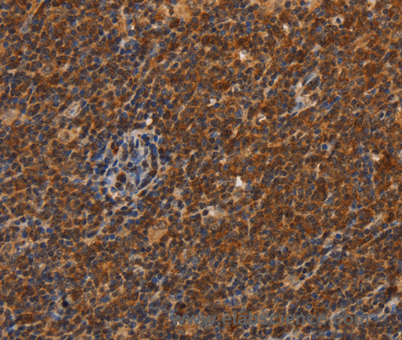 Immunohistochemistry of paraffin-embedded Human Lymphoma using CDC34 Polyclonal Antibody at dilution of 1:50