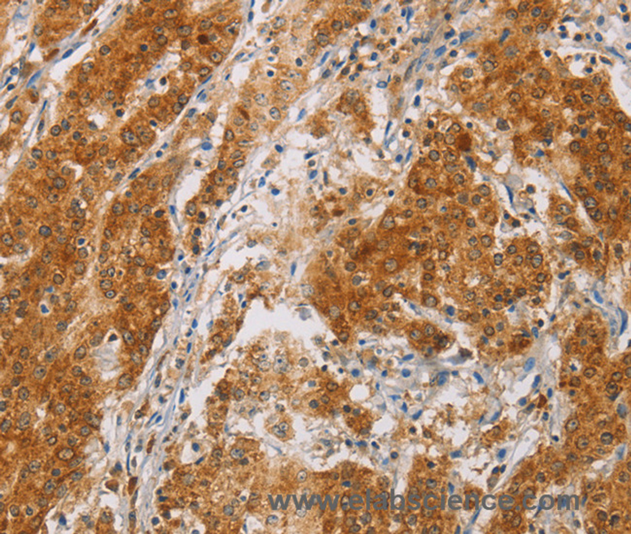 Immunohistochemistry of paraffin-embedded Human gasrtic cancer tissue using CENPE Polyclonal Antibody at dilution 1:50
