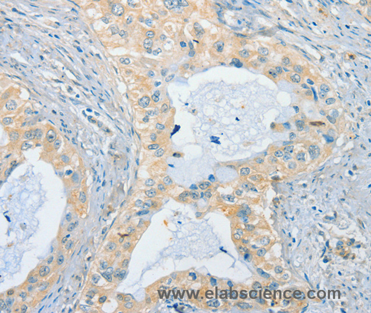 Immunohistochemistry of paraffin-embedded Human cervical cancer using CHRNA2 Polyclonal Antibody at dilution of 1:40