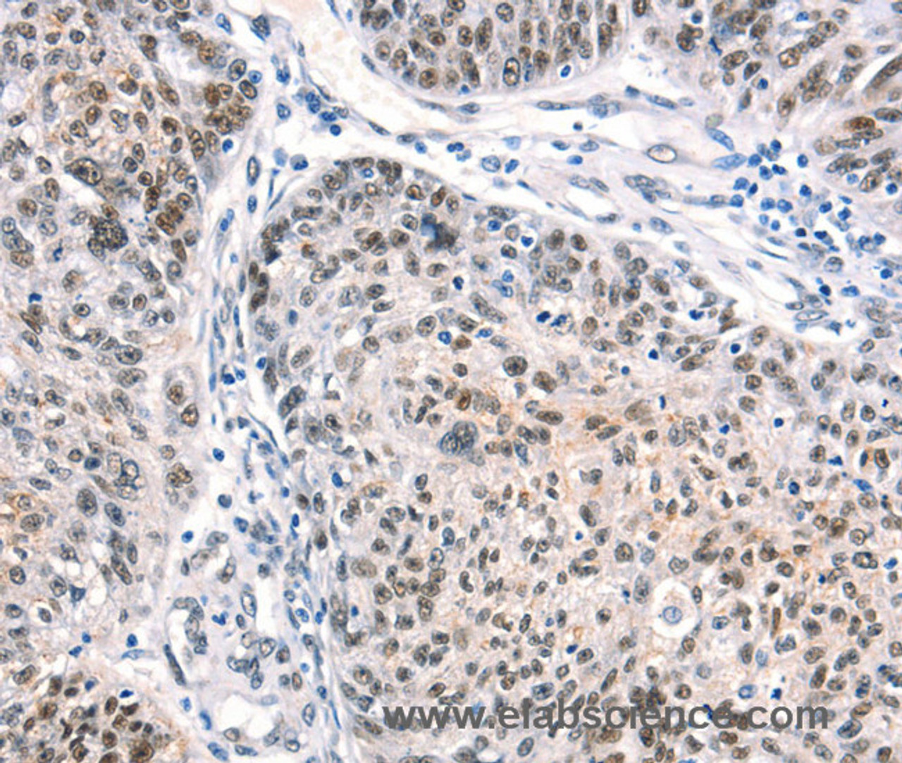 Immunohistochemistry of paraffin-embedded Human ovarian cancer using CTBP2 Polyclonal Antibody at dilution of 1:40