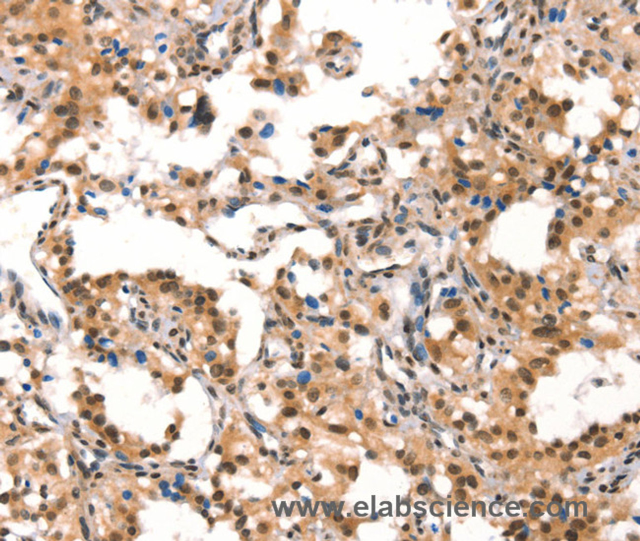 Immunohistochemistry of paraffin-embedded Human thyroid cancer tissue using CUL4B Polyclonal Antibody at dilution 1:50