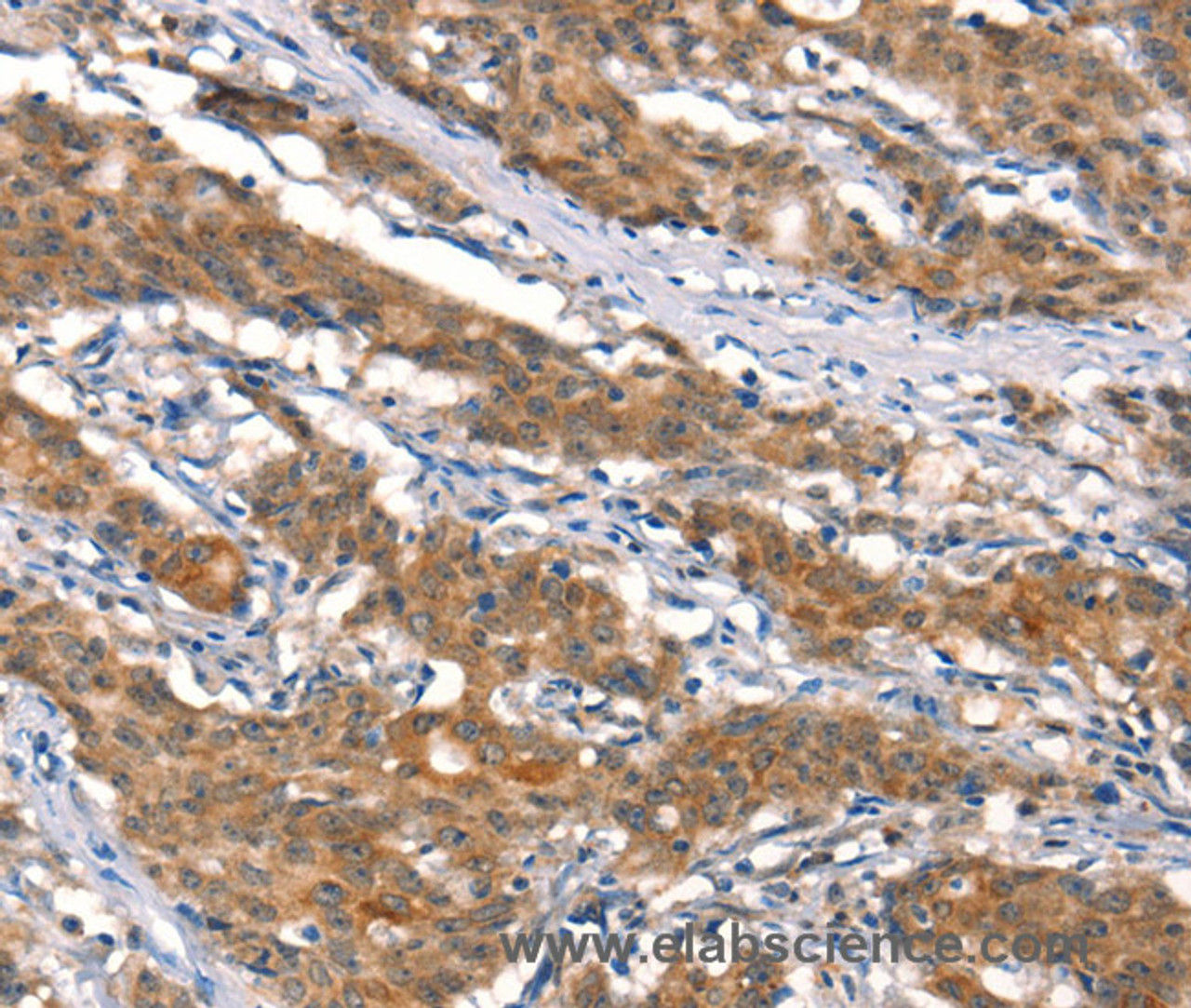 Immunohistochemistry of paraffin-embedded Human gastric cancer tissue using CUL4B Polyclonal Antibody at dilution 1:50