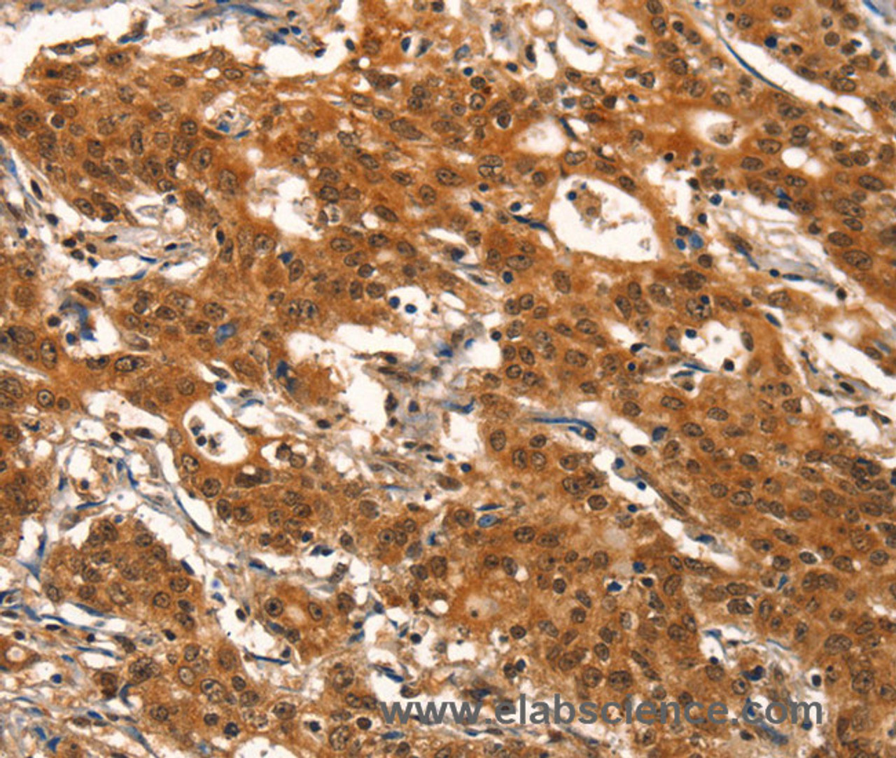 Immunohistochemistry of paraffin-embedded Human gasrtic cancer tissue using DEAF1 Polyclonal Antibody at dilution 1:40