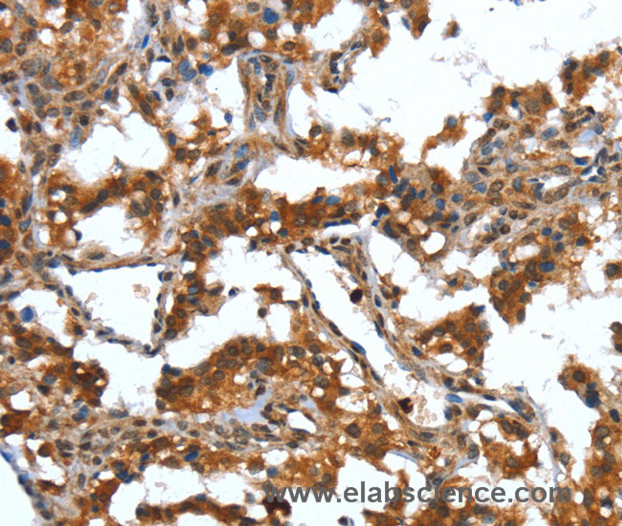 Immunohistochemistry of paraffin-embedded Human thyroid cancer tissue using DEFA4 Polyclonal Antibody at dilution 1:40