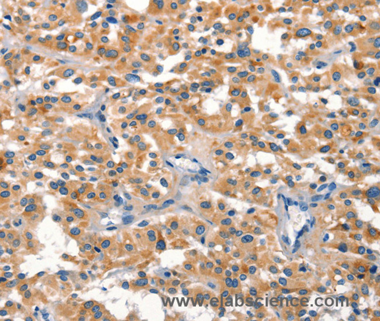Immunohistochemistry of paraffin-embedded Human thyroid cancer using DUSP2 Polyclonal Antibody at dilution of 1:30