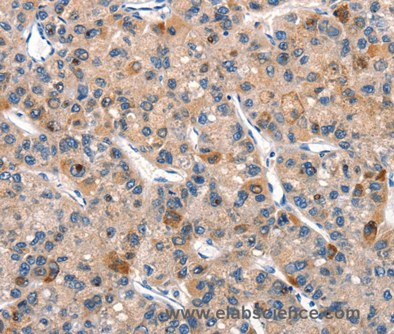 Immunohistochemistry of paraffin-embedded Human liver cancer using DUSP2 Polyclonal Antibody at dilution of 1:30