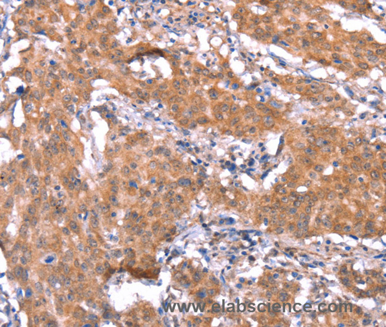 Immunohistochemistry of paraffin-embedded Human gastric cancer tissue using FAM13B Polyclonal Antibody at dilution 1:30