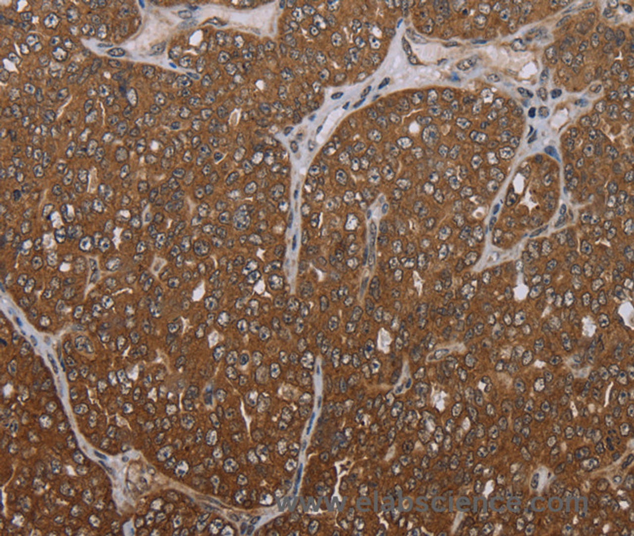 Immunohistochemistry of paraffin-embedded Human ovarian cancer tissue using FOLH1B Polyclonal Antibody at dilution 1:30