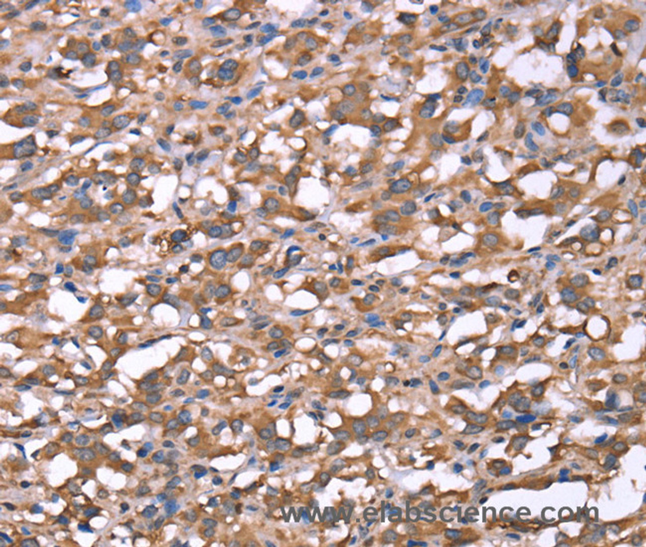 Immunohistochemistry of paraffin-embedded Human thyroid cancer tissue using SPAST Polyclonal Antibody at dilution 1:40