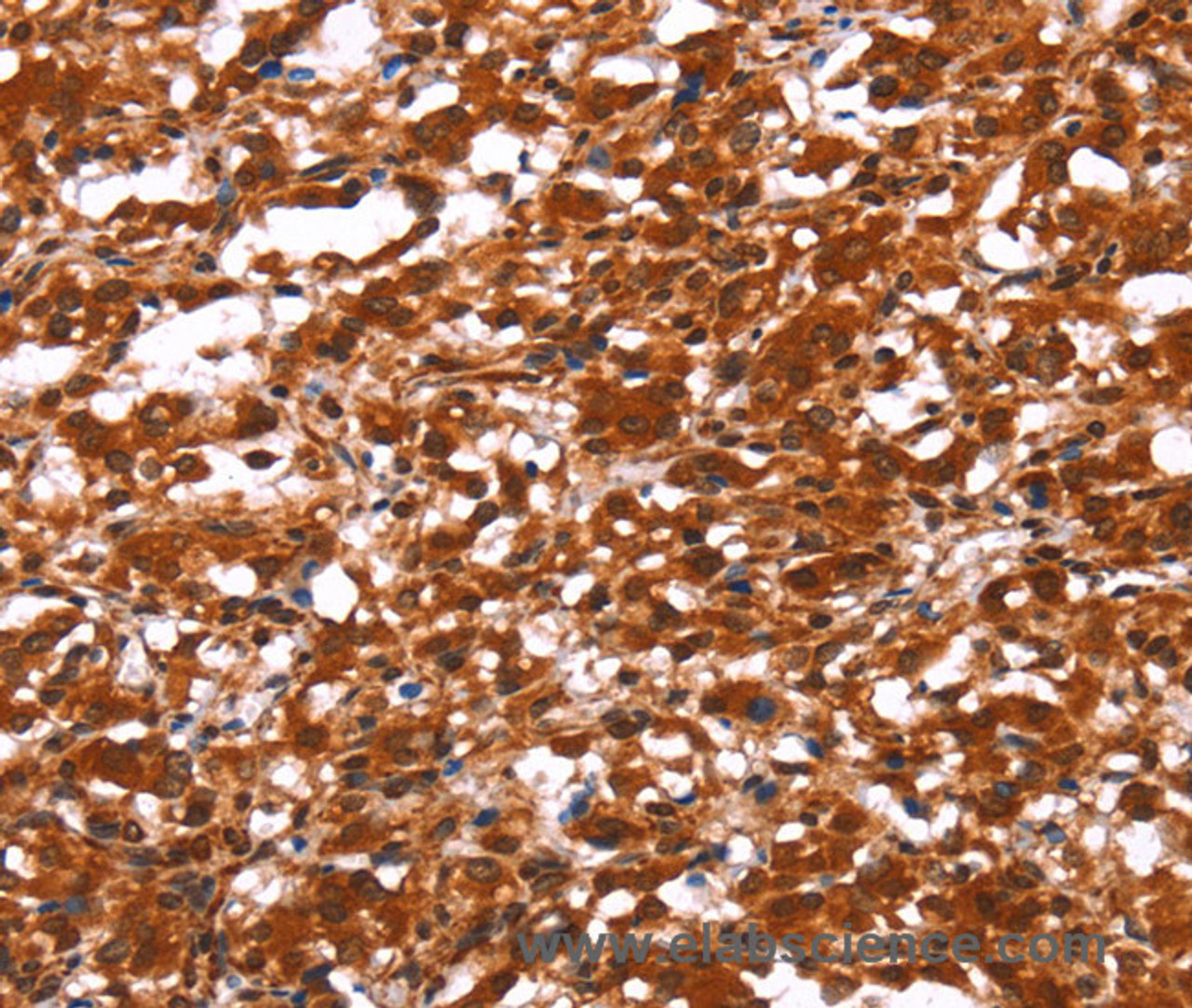 Immunohistochemistry of paraffin-embedded Human thyroid cancer using FUT1 Polyclonal Antibody at dilution of 1:30