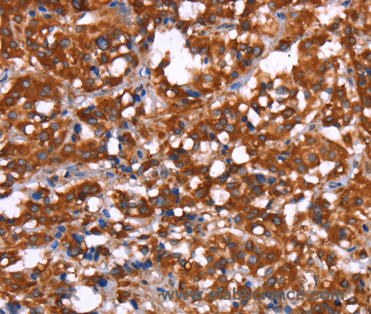 Immunohistochemistry of paraffin-embedded Human thyroid cancer tissue using GAGE12I Polyclonal Antibody at dilution 1:30