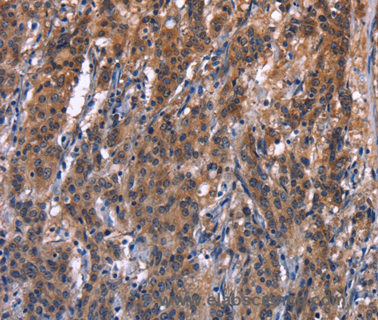 Immunohistochemistry of paraffin-embedded Human gastric cancer tissue using R3HCC1L Polyclonal Antibody at dilution 1:40