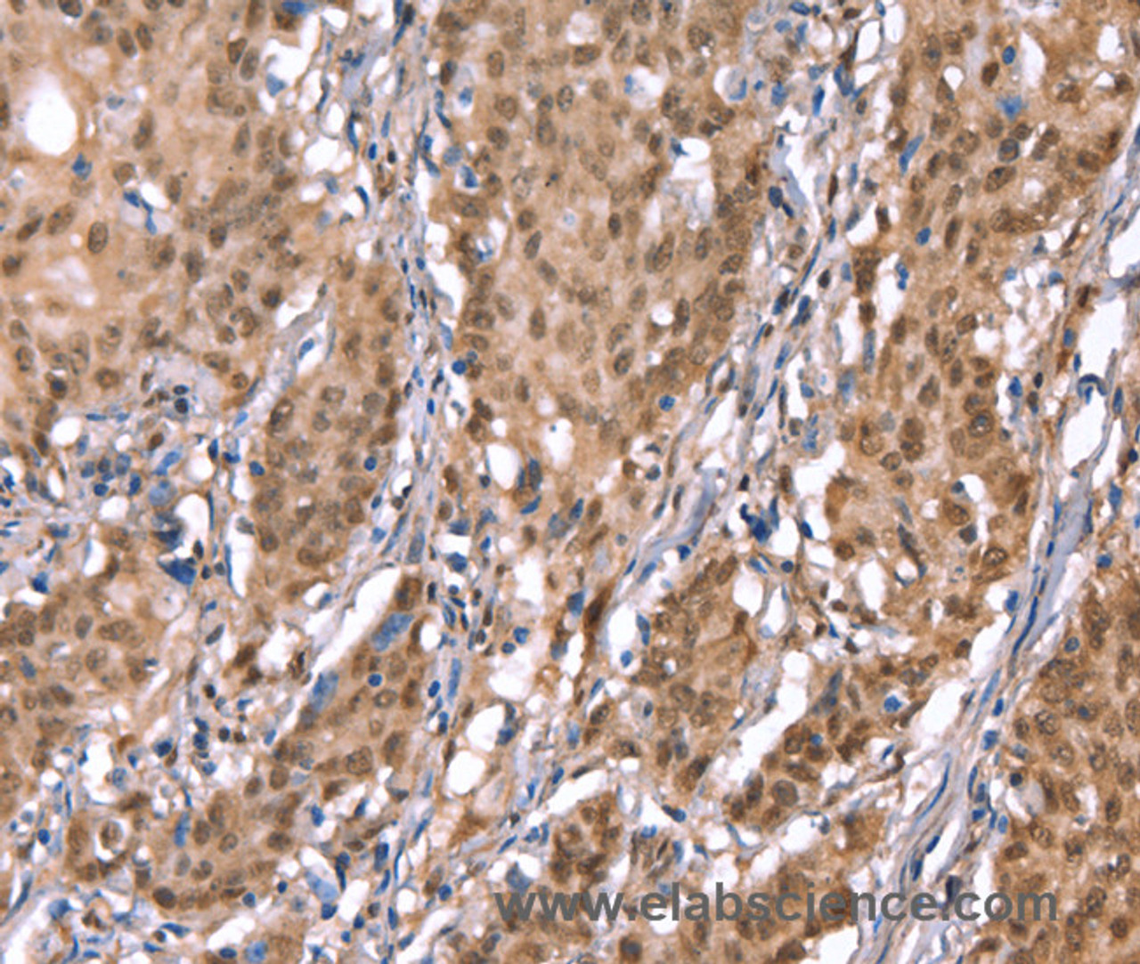 Immunohistochemistry of paraffin-embedded Human gasrtic cancer tissue using KCNJ6 Polyclonal Antibody at dilution 1:40