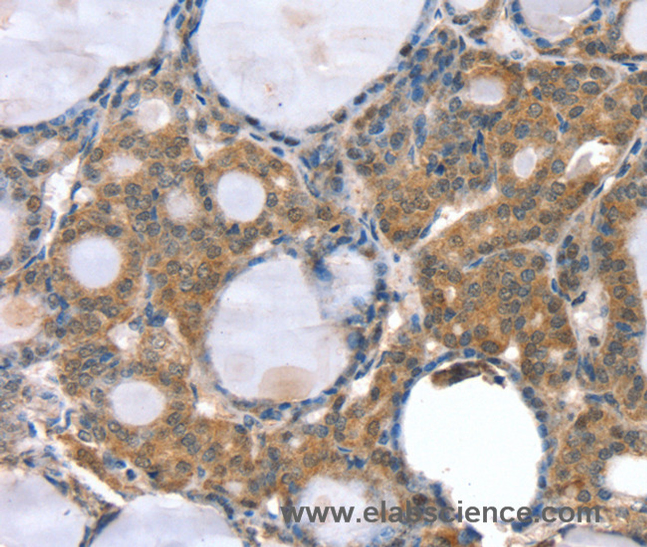 Immunohistochemistry of paraffin-embedded Human thyroid cancer using GNAT3 Polyclonal Antibody at dilution of 1:35