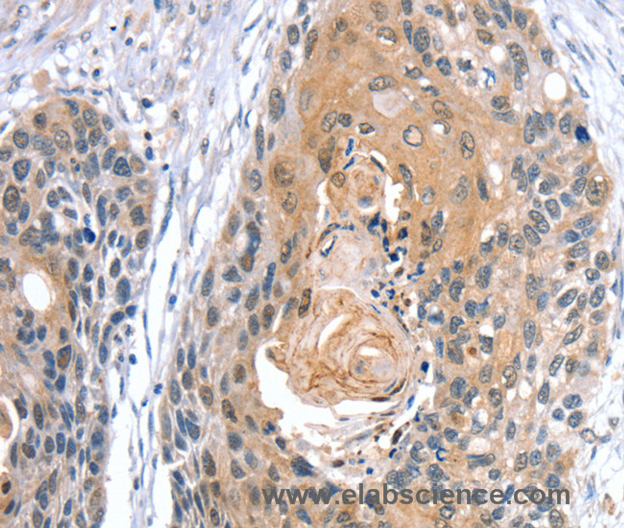Immunohistochemistry of paraffin-embedded Human esophagus cancer using GNAT3 Polyclonal Antibody at dilution of 1:35